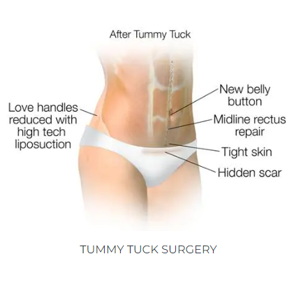 Abdominoplasty Surgery (aka tummy-tuck)