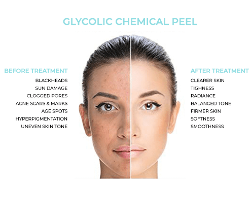 Glycolic Chemical Peel