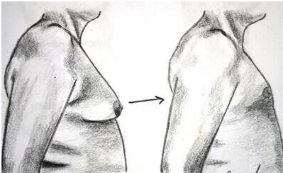 Male Breast Reduction (Gynecomastia)