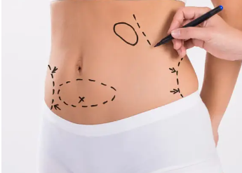 Liposuction Surgery