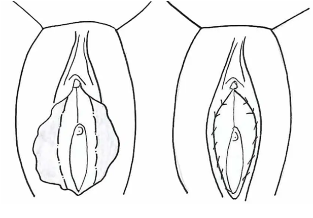 Labiaplasty 