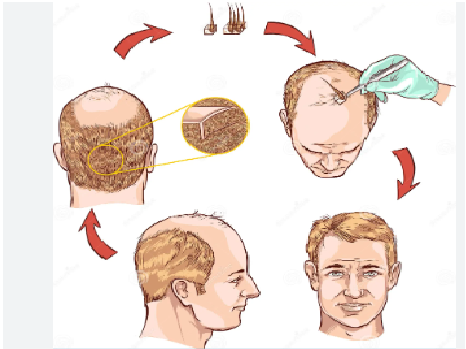 Hair Transplantation